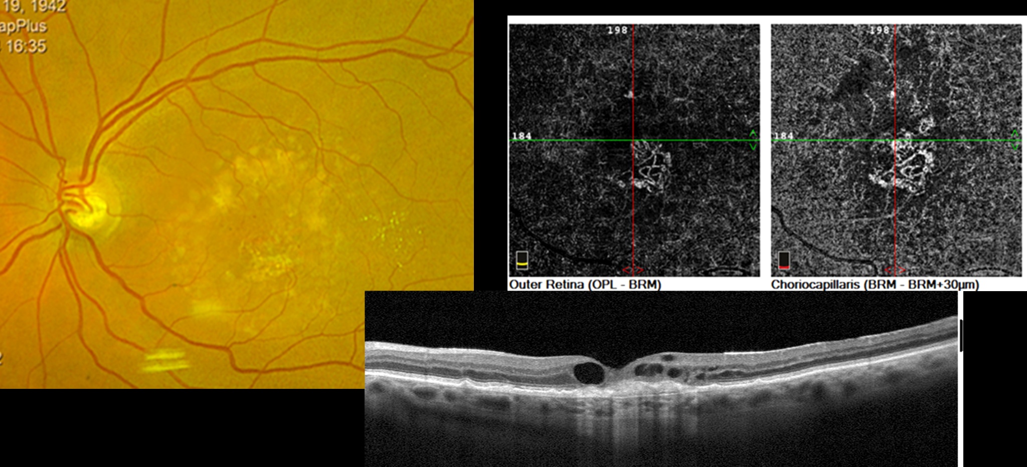 Imagen de degeneración macular húmeda con neovasos coroideos. Evaluación por especialista en retina.