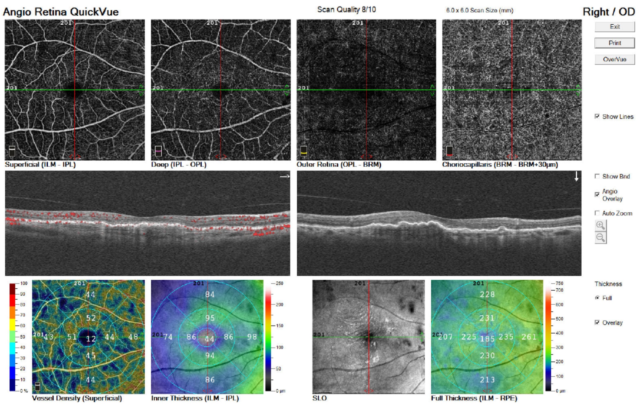 OCT de degeneración macular húmeda después del tratamiento intravítreo con anti-VEGF.