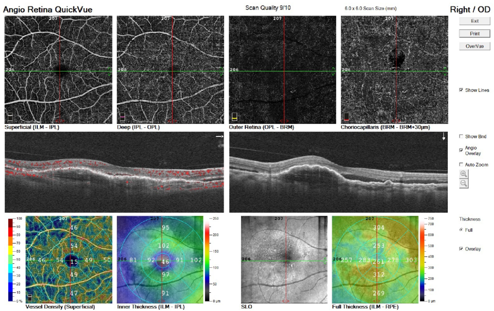 OCT de degeneración macular húmeda antes del tratamiento intravítreo.