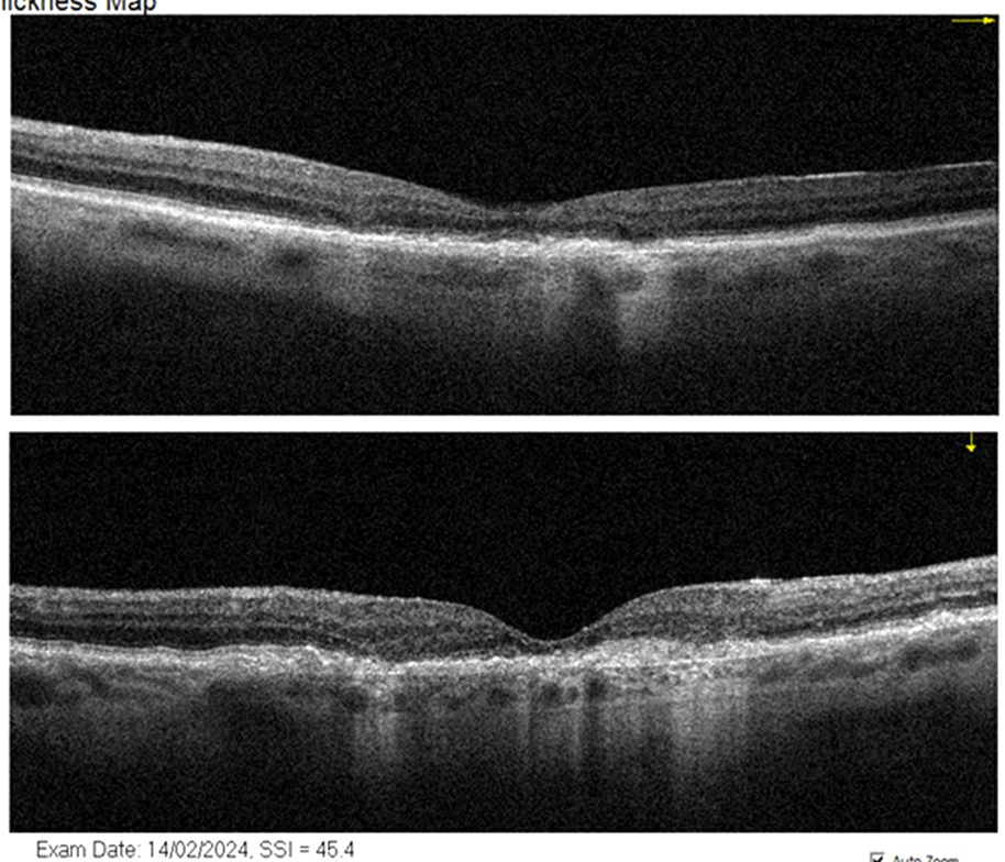Imagen de degeneración macular seca. Cambios en la mácula evaluados por especialista en retina en Santiago.