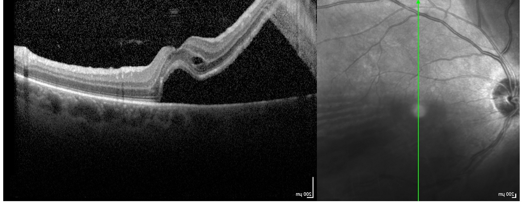 OCT retinal de alta resolución para diagnóstico de desprendimiento de retina en Santiago.