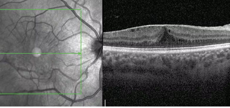 OCT de membrana epirretiniana — imagen de tomografía de coherencia óptica macular
