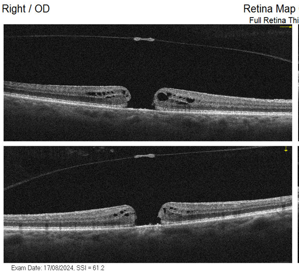 OCT de agujero macular — imagen de tomografía de coherencia óptica preoperatoria