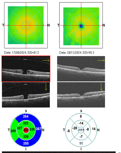 OCT secuencia preoperatoria y postoperatoria de agujero macular — evolución quirúrgica