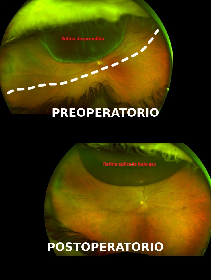 Optomap de fondo de ojo con desprendimiento de retina. Comparación preoperatoria y postoperatoria.