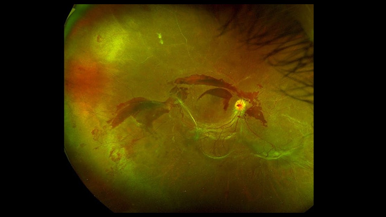Optomap de fondo de ojo mostrando retinopatía diabética — imagen de campo ultra amplio