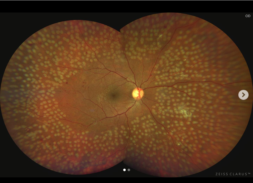 Imagen post fotocoagulación láser — retinopatía diabética