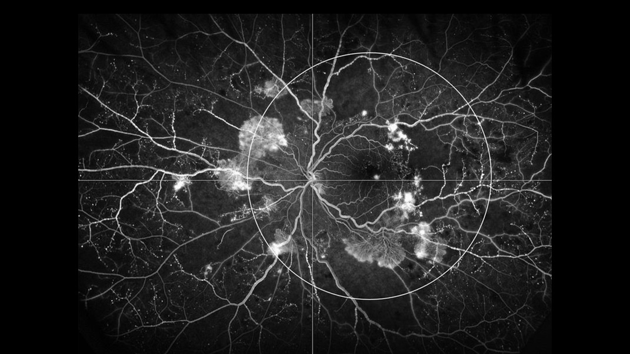 Angiografía de campo ultra amplio en retinopatía diabética — evaluación de perfusión retinal