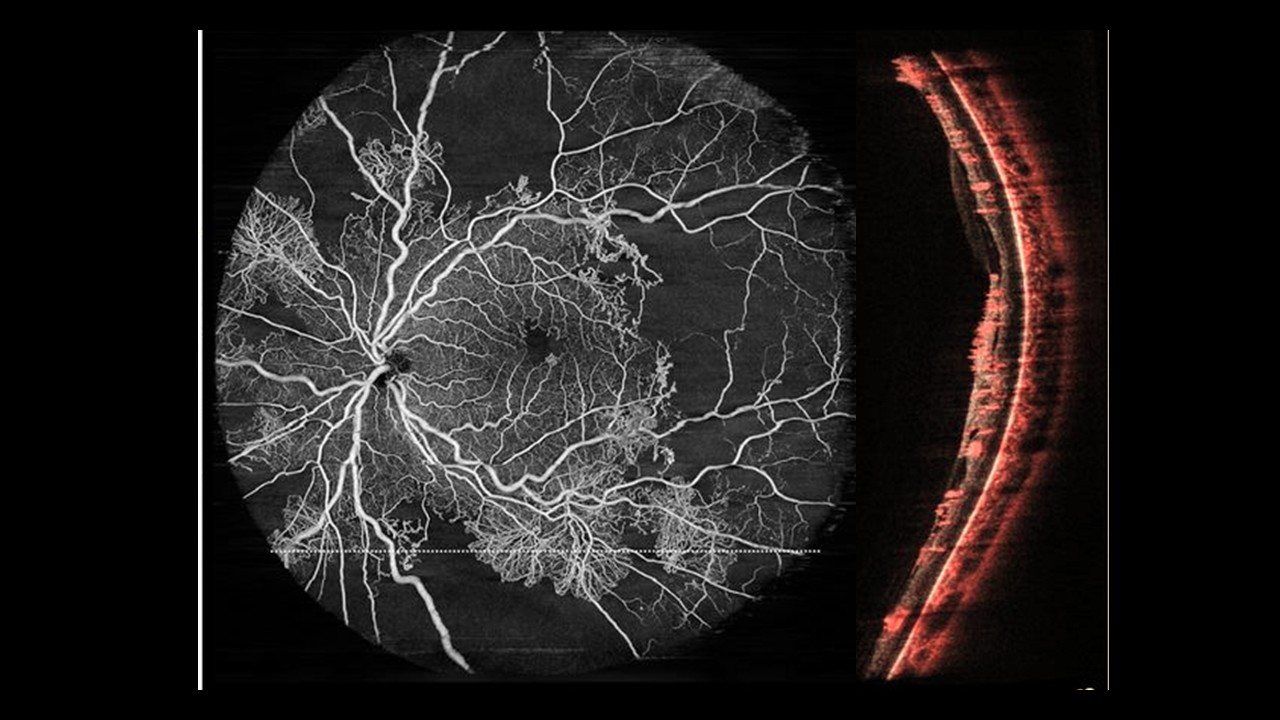 OCT de campo amplio para seguimiento de retinopatía diabética